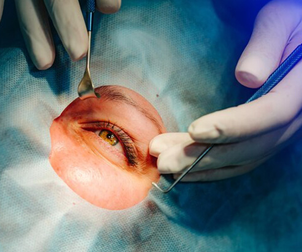 Occuloplasty Eye Procedure in Siliguri