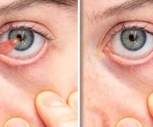 Pterigium Eye Treatment In Siliguri