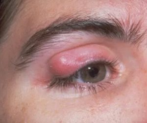 Ikshana Eye Clinic Chalazion Cyst Entropion